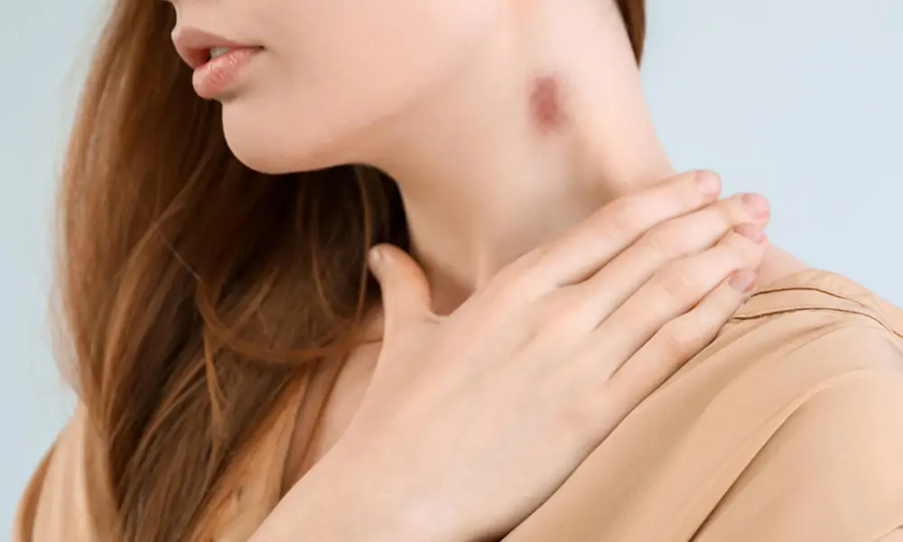 remove hickeys