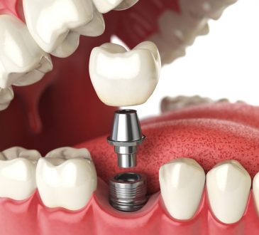 Dental Implants