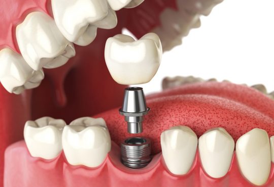 Dental Implants