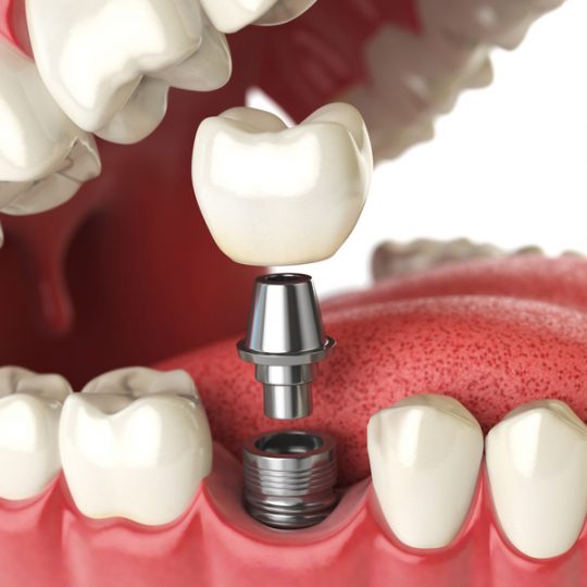 Dental Implants